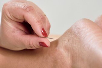 Acupuncture for Chronic Pain Management