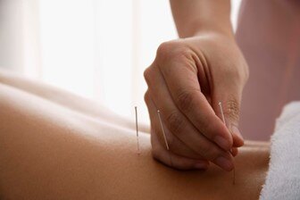 Cupping Therapy and Acupuncture